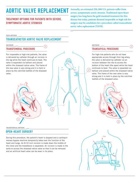 Bicuspid Aortic Valve, Aortic Valve Replacement, Cardiothoracic Surgery, Heart Stuff, Brand Storytelling, Heart Valves, Family Nurse Practitioner, Open Heart Surgery, Cardiac Nursing