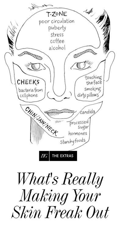 An Ayurvedic approach to why your t-zone, cheeks, or jawline acne is giving you fits Doterra Acne, Gesicht Mapping, Jawline Acne, Face Map, Face Mapping Acne, Skin Care Routine For 20s, Face Mapping, Types Of Acne, Moisturizer For Oily Skin