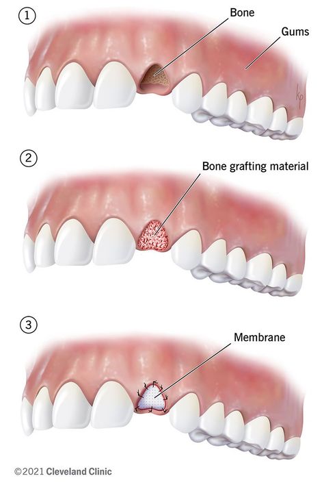 Dental Bone Graft: Process, Healing & What It Is Maxillary Sinus, Types Of Bones, Bone Grafting, Dental Implant Surgery, Gum Recession, Oral Surgeon, Restorative Dentistry, Mad Max Fury, Bone Loss