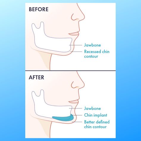 This is a great illustration showing what a difference a chin implant can make. Find out more about chin implant surgery from the American Board of Cosmetic Surgery: https://www.americanboardcosmeticsurgery.org/procedure-learning-center/facial-procedures/chin-implants/ #implantech #superiorpatientaesthetics  #chinimplant #chin #chinaugmentation #transformation #beforeafter #facialprocedure #facialimplant #plasticsurgeon #cosmeticsurgeon #surgeon #plasticsurgery #cosmeticsurgery Chin Implant Before And After Women, Chin Implant Woman, Chin Surgery, Chin Implant Before And After, Weak Chin, Silicone Implants, Chin Augmentation, Chin Implant, Nose Reshaping