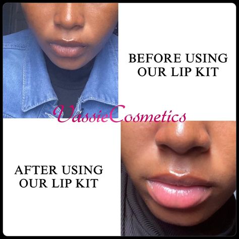 Our SPECIALIZED LIP CARE KITS are carefully designed to help get rid of Dark , Dry and Chapped Lips 👄 SWIPE TO SEE SOME OF OUR CLIENTS REVIEWS & TRANSFORMATION➡️➡️➡️ How To Use: 👄FLUFFY LIP SCRUB: The first step to achieving a healthy lips is regular exfoliation. Helps to remove dried skin cells on the lips making it soft,smooth and supple. Helps with easier penetration of the other lip care products. Use 2-3x weekly 👄LIP THERAPY BALM: Our Lip Therapy Balm helps treat dry/chapped lips an... Lips Balm, Lip Care Products, Pink Lip Balm, Lip Care Tips, Lip Masks, Dry Flaky Skin, Lip Therapy, Lip Care Routine, Healthy Lips