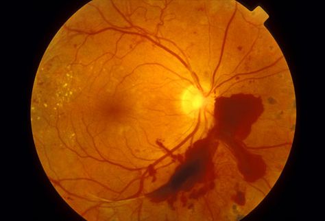 diabetic retinopathy with retinal hemorrhages Ophthalmology Notes, High Blood Sugar Remedies, Eye Diseases, Kidney Pain, Eye Damage, Vision Loss, Eye Exam, High Blood Sugar, Human Eye