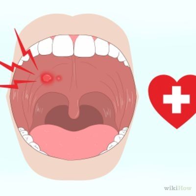 Blisters In Mouth Remedies, How To Get Rid Of Sores In Your Mouth, Roof Of Mouth Sore Remedy, Burnt Roof Of Mouth Remedy, Mouth Sore Remedy How To Get Rid, How To Get Rid Of Mouth Ulcers, Blister On Tongue, Blister In Mouth, Roof Of Mouth Sore