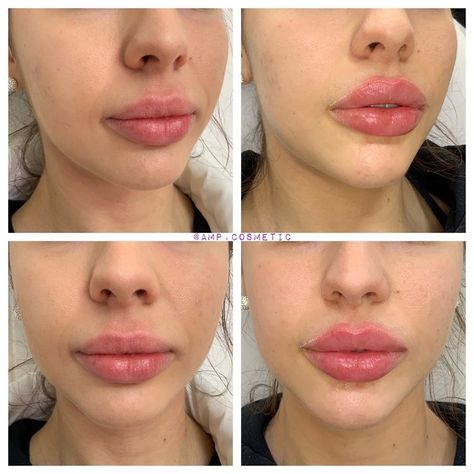 0.5ml Lip Filler Before And After, .5ml Vs 1ml Lip Filler, .5ml Lip Filler, 0.5 Ml Lip Filler Before And After, Cosmetic Nurse, 1.5 Ml Lip Filler, Nurse Injector, Lip Combos, Lip Filler