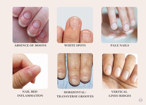 6 Signs Your Fingernails Are Trying To Tell You Something - Organic Olivia » Organic Olivia Finger Nail Health, Strong Healthy Nails, Nail Therapy, Natural Fingernails, Finger Nails Health, Nails Health Signs, Nail Deficiency Signs, Toenail Health Signs, Unhealthy Fingernails