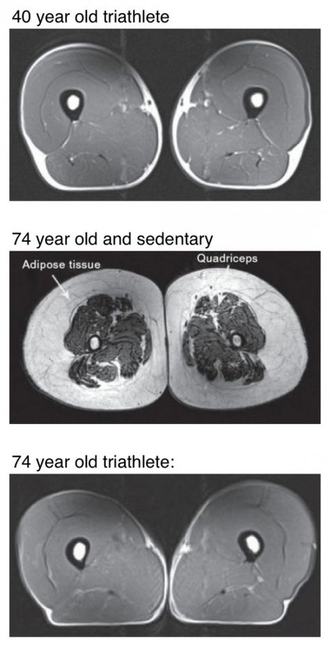 This is an MRI cross section of a 74yo sedentary test subject. Check out the site to compare it to the cross sections from an athlete of the same age as well as from a 40yo athlete. Shocking. Mri Scan, Adipose Tissue, Save Your Life, Leg Muscles, What Really Happened, Sports Medicine, Sport Motivation, I Work Out, Muscle Mass