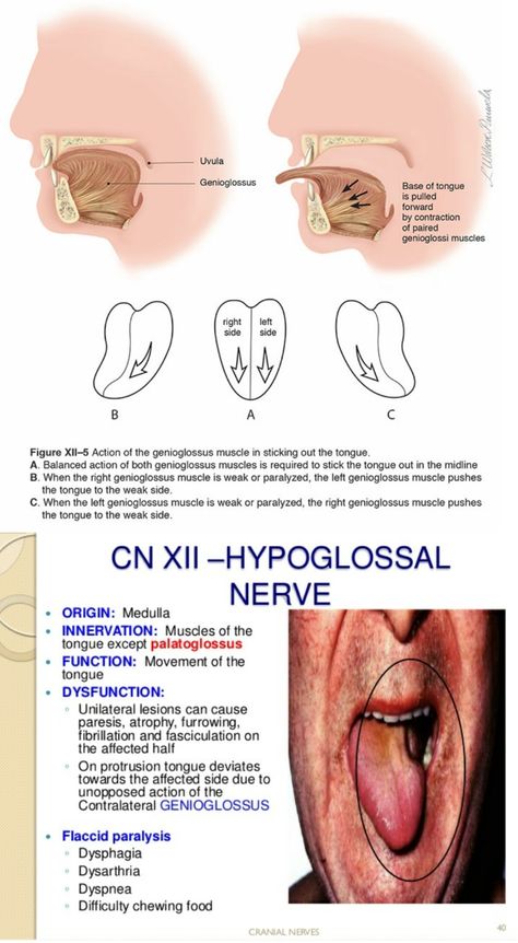 Hypoglossal nerve injury - Deviation of Tongue "towards the affected" side ... #genioglossus 【 All muscles of tongue is Supplied by Hypoglossal nerve ... Except "Palatoglossus" supplied by spinal part of Acessory nerve 】 Tongue Muscles Anatomy, Muscles Of Tongue, Tongue Muscles, Hypoglossal Nerve, Nerve Injury, What Is Intelligence, Myofunctional Therapy, Newborn Nursing, Dental Assisting