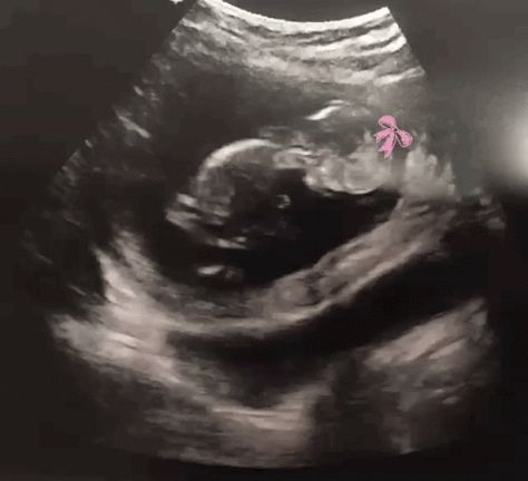 Ultrasound Lying GIF - Ultrasound Lying Malala - Discover & Share GIFs Ultrasound Video Pregnancy, 19 Weeks Pregnant Ultrasound, 8 Weeks Pregnant Ultrasound, 8weeks Pregnant Ultrasound, 4 Weeks Pregnant Ultrasound, Upturned Nose, Baby Ultrasound, Diamond Face, Rock Outfits