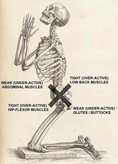 Lower Crossed Syndrome: What is it, Why is it a Problem, and How You Should be Addressing it. Psoas Stretch, Myofascial Pain Syndrome, Sciatica Stretches, Hip Flexor Exercises, Hip Pain Relief, Chronic Lower Back Pain, Pain Relief Remedies, Sciatica Exercises, Back Stretches For Pain