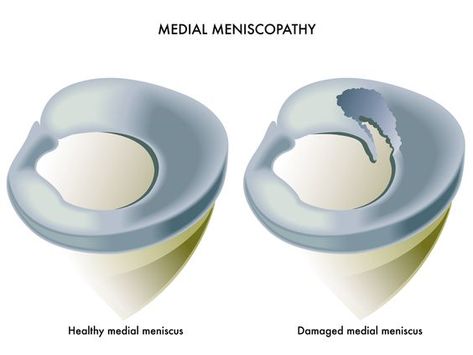 Medial Meniscus, Knee Anatomy, Knee Meniscus, Meniscus Surgery, Knee Replacement Exercises, Knee Pain Relief Remedies, Meniscal Tear, Knee Pain Relief Exercises, Knee Strengthening Exercises