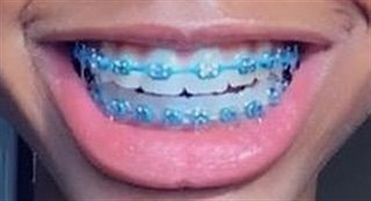 Light Blue Braces, Dental Braces Colors, Braces Colors Combinations, Invisible Teeth Braces, Blue Braces, Natural Teeth Whitening Diy, Cute Braces Colors, Kids Braces, Pretty Teeth