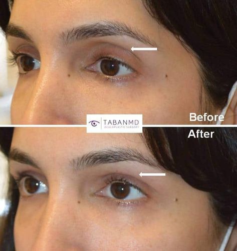 Eyelid Filler Injection Before and After Gallery | Taban MD Eyelid Filler, Filler Injection, Cosmetic Fillers, Under Eye Fillers, Eyes Contact, Face Fillers, Sunken Eyes, Tear Trough, Bulging Eyes