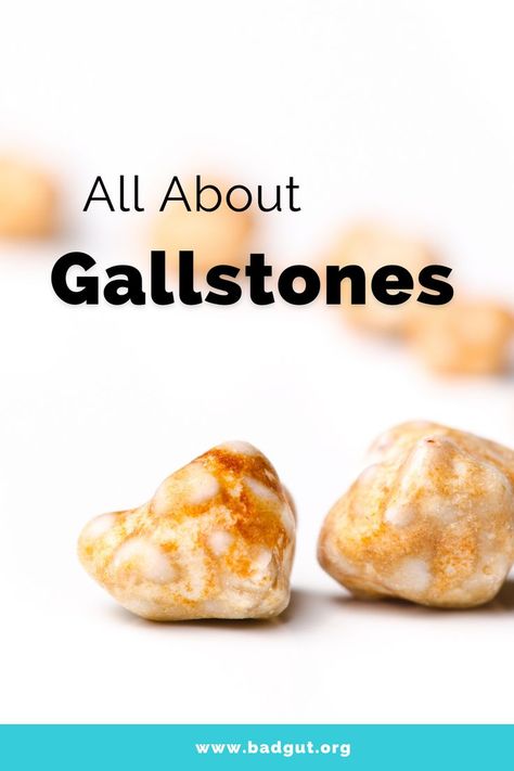 What are Gallstones? How are Gallstones formed? How are Gallstones diagnosed? How are Gallstones treated? Find out at badgut.org. #gallstones #badgut Gallstone Friendly Desserts, Gallstone Diet Meals Food, Gall Stone Diet, Gallstone Pain Relief, Gallstone Diet Meals, Gallstone Symptoms, Gallstone Cleanse, Gallbladder Stones Diet, Gallbladder Removal Diet