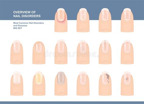 Nail Diseases And Disorders Chart, Nail Disorders And Diseases, Blue Nail Polish Colors, Nail Disorders, Diseases And Disorders, Clothes Videos, Fluorescent Nails, Best Summer Nail Color, Different Types Of Nails