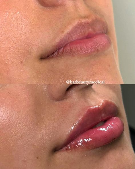 This client came in wanting a subtle and natural lip enhancement. Our nurse injector @aesthetic.nurse.rebecca used 0.65ml to achieve this look 💉🤍 Nurse Injector Aesthetic, Injector Aesthetic, Aesthetics Nurse, Aesthetic Nurse Injector, Career Plan, Aesthetic Nurse, Nurse Injector, Spa Ideas, Lip Enhancement