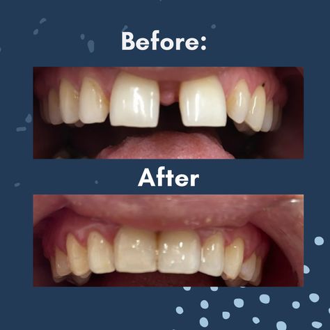 You shouldn't have to wait 2 years for straight teeth. Thank you @ClearAlignerSharrow for sharing this #SmileTransformation with us! #SixMonthSmiles Invisible Aligners and Clear Braces are designed to straighten your teeth in about 6 MONTHS. #TrustTheProcess #SmileGoals Braces Before And After Overbite, Braces Or Invisalign, Braces Memes Humor, Clear Braces, Invisalign Memes, Straight Teeth, Trust The Process, Braces