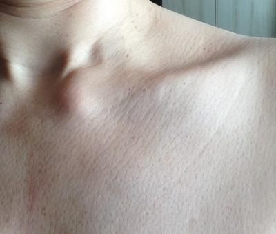 A swollen sterno clavicular joint is usually Tietze's syndrome. I have had a hard lump on my collar bone near my throat, swollen collar bones & sternum How To Get Collar Bones, Collar Bone Exercise, Lee Fletcher, Clavicle Bone, Beauty Bone, Lump In Throat, Torso Anatomy, Neck Bone, Neck Bones