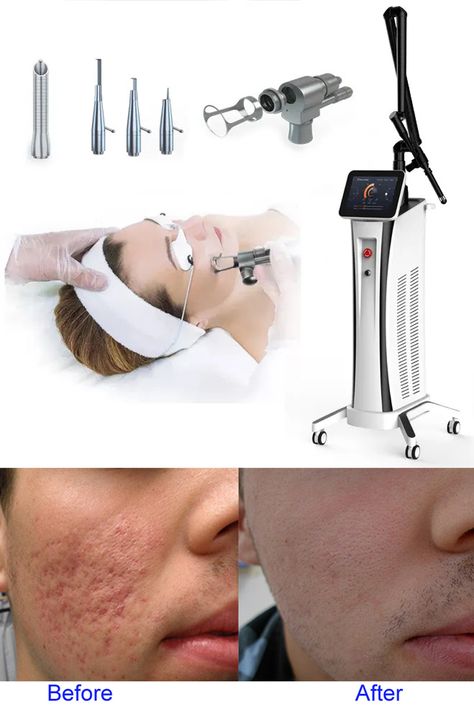 The CO2 laser skin resurfacing machine system uses a high-energy laser to create orderly conical holes in the skin, which can effectively stimulate collagen growth and sufficiency. Bvlaser Bestview is a dermatology CO2 laser machine factory manufacturer, we have the best CO2 fractional laser machine sale. Carbon Laser, Laser Skin Resurfacing, Fractional Laser, Laser Resurfacing, Beauty Room Design, Aesthetic Medicine, Skin Resurfacing, Laser Tattoo, Laser Tattoo Removal