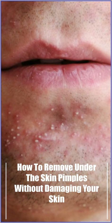 How To Remove Under The Skin Pimples Without Damaging Your Skin Pimple Meaning, Under The Skin Pimples, Under The Skin Acne, Orange Eye Makeup, Blind Pimple, Lights Mirror, Pimples Under The Skin, Makeup Morphe, Scar Remover