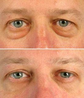 Removing Eye Bags, Workout Techniques, Aerobics Exercises, Puffy Bags, Reduce Eye Wrinkles, Baggy Eyes, Eye Wrinkles, Eye Problems, Facial Toning