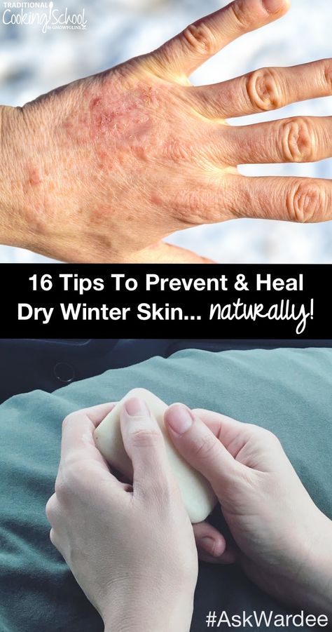 Does dry winter skin keep you scratching or in pain? Do you feel like you can't get enough lotion to heal your dry, cracking, or bleeding skin? Watch, listen, or read for my 16 tips to prevent and heal dry winter skin naturally, plus learn the BEST things to put on your skin to keep it moisturized (hint: it's NOT lotion!). Severe Dry Skin Remedies, Dry Skin Remedies For Body Winter, Best Lotion For Dry Skin Winter, Extreme Dry Skin Remedy, Dry Winter Skin Remedies, Dry Hands Remedy, Homemade Creams, Medicine Recipes, Dry Hand Skin