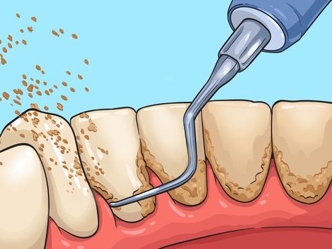 How To Remove Hardened Plaque, How To Get Rid Of Plaque Build Up, How To Get Plaque Off Teeth, Diy Plaque Remover Teeth, How To Remove Plaque From Teeth, How To Clean Plaque From Teeth, Teeth Plaque Removal At Home, Clean Teeth Plaque How To Remove, Removing Plaque From Teeth At Home