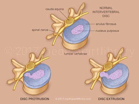 License Image The intervertebral disc is made up of an outer ring called the anulus fibrosus, and an inner core of a soft gelatinous substance called the nucleus pulposus. The anulus fibrosus is composed of fibrous tissue and fibrocartilage laminae arranged in concentric rings. When a disc is injured or becomes less flexible with age, … Brain Lobes, Vertebral Artery, Occipital Lobe, Anatomy Images, Muscles Of The Face, Intervertebral Disc, Peripheral Nervous System, Cerebral Cortex, Facial Nerve