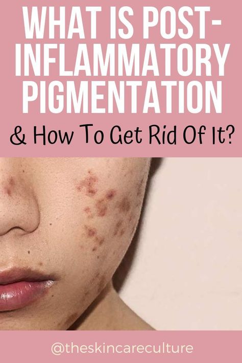 What is PiH and what causes it? How is this condition affected by acne? Click to find out. Increase Melanin, Skin Care Routine For Teens, Forehead Acne, Post Inflammatory Hyperpigmentation, Homemade Facials, Lighter Skin, Daily Skin Care Routine, Daily Skin Care, How To Treat Acne