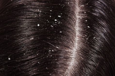 Photo dandruff on her dark hair | Premium Photo #Freepik #photo #hair-problem #skin-disease #human-skin #dry-hair Diy Hair Spray, Home Remedies For Dandruff, Overnight Hair Mask, Aloe For Hair, Rid Of Dandruff, Dandruff Hair, Short Natural Curly Hair, Dandruff Remedy, Getting Rid Of Dandruff