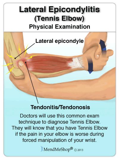 Treating Tennis Elbow After Diagnosis. Too many people only focus on suppressing pain symptoms while providing less attention to the true healing aspects of the body. Scar tissue can remain for months after one gets to a point of being relatively pain-free. However, as long the weak and brittle scar tissue remains, you are susceptible to re-injury or re-aggravation. Punkty Spustowe, Elbow Brace, Golfers Elbow, Elbow Braces, Elbow Pain, Muscle Anatomy, Tennis Elbow, Medical Anatomy, Hand Therapy