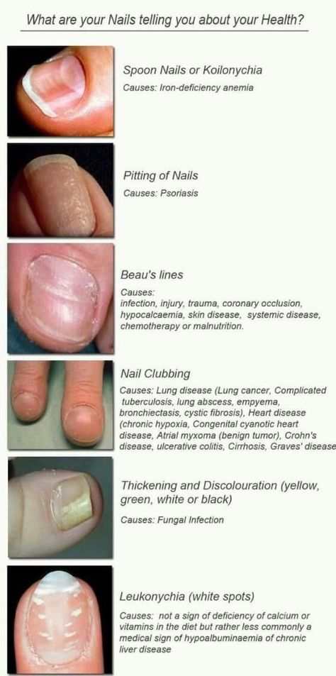 Nail Health Signs, Med Aesthetic, Nail Anatomy, Forensic Medicine, Dermatology Nurse, Nail Disorders, Nail Conditions, Nail Problems, Health Chart