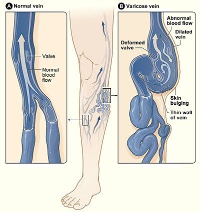 How to Prevent Varicose Veins Home Remedies For Spiders, Varicose Vein Remedy, Venous Insufficiency, Stubborn Belly Fat, Health Remedies, Apple Cider, Budapest, Home Remedies, Natural Remedies