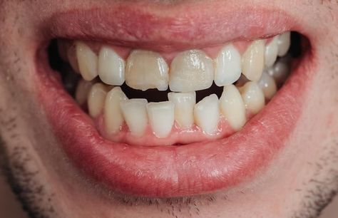 Crooked, chipped, or discolored teeth can be unappealing and impact your self-confidence. On the other hand, when you smile confidently, you can make a great impression. Cracked Tooth, Losing Teeth, Misaligned Teeth, Teeth Drawing, Discolored Teeth, Crooked Teeth, Dental Emergency, Old Town Scottsdale, Dental Braces