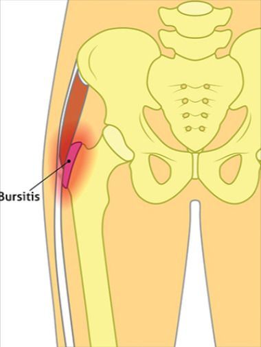 Hip Bursa Symptoms, What Is Bursitis Hip Pain, Outer Hip Pain, Bursitis Hip Relief, Hip Pain Exercises, Hip Pain Causes, Hip Pain Relief Remedies, Hip Flexor Exercises, Bursitis Hip