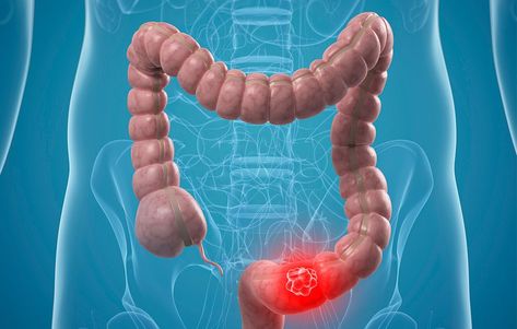 If Jimmy Kimmel Can Handle a Colonoscopy on TV, You Can Get One, Too Vitamin D Symptoms, Vitamin D Side Effects, Cinnamon Health Benefits, Vitamin D Deficiency, Types Of Cancers, Honey And Cinnamon, Warning Signs, Vitamin D, Human