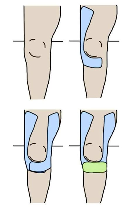 How to Apply Tape for Knee Pain: 4 Techniques - Injury Health Blog Knee Stability Taping, Kt Tape For Knee Support, How To Use Kt Tape On Knee, Sports Tape Knee, How Do You Kt Tape Your Knee, Knee Support Taping, How To Put Kt Tape On Your Knee, Knee Tape Support, How To Tape Knee For Support