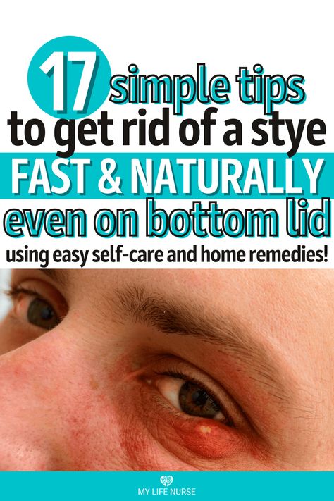 person's eye with stye on bottom lid Sty Remedy How To Get Rid, Sty In The Eye Remedies How To Get Rid, Get Rid Of A Stye Overnight, Stye Remedies Fast Essential Oils, Stye Remedies Fast How To Get Rid At Home, Remedies For Stye On Eyelid, How To Get Rid Of Stye Eye, Sty Eye Remedies How To Get Rid, Natural Stye Remedies