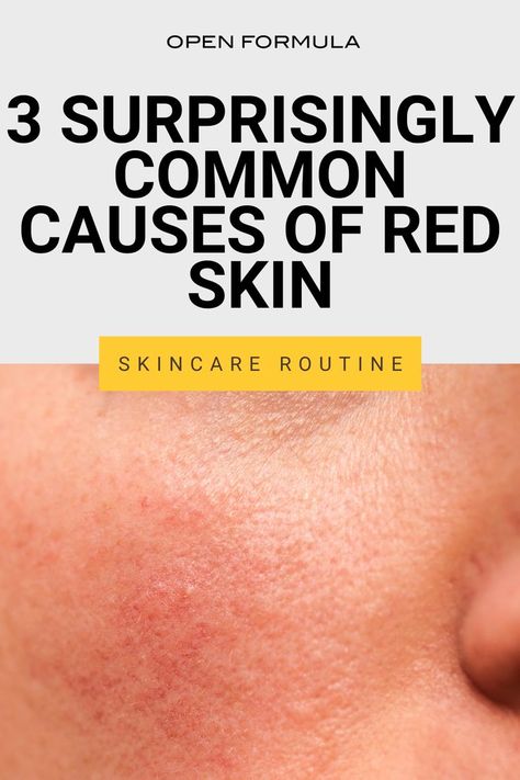 Do you know these three common causes of red skin? Here our tips for dealing with skin redness plus the best skincare products to use. What Helps With Redness On Face, Remedies For Redness On Face, Redness Relief Skin Care, How To Get Rid Of Red Face, Skincare Routine For Redness, Skin Care Reduce Redness, Red Skin Remedies Faces, Skincare Products For Redness, Best Skincare For Redness