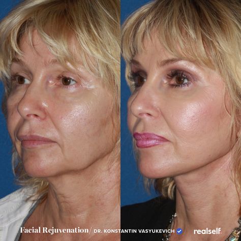 More Defined Jawline, Sagging Neck Skin, Chin Wrinkles, Neck Lift Surgery, Home Facial Treatments, Defined Jawline, Face Procedures, Sagging Neck, Laser Facial