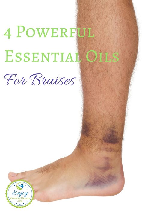 Bruising easily? These powerful oils will help you heal your bruises fast! Essential Oil For Bruising, Essential Oil Remedy, Oil Remedies, Essential Oils Health, Yl Essential Oils, Essential Oils Herbs, Essential Oil Benefits, Living Essentials Oils, Essential Oils Recipes