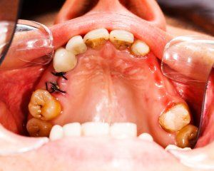 TOOTH EXTRACTION: ALL YOU NEED TO KNOW ABOUT HAVING A TOOTH REMOVED Tooth Extraction Aftercare, Wisdom Teeth Funny, Tooth Extraction Healing, Dentist Day, Molar Tooth, Sensitive Teeth Remedy, Teeth Whitening Homemade, Tooth Removal, Wisdom Teeth Removal