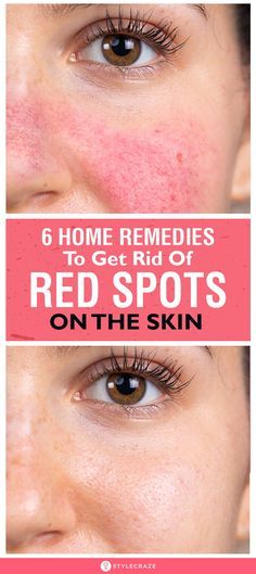 Diy Face Redness Remedy, Skin Spots On Face, Get Rid Of Facial Redness, Remedies For Redness On Face, How To Get Rid Of Red Face, Redness Reducing Skin Care Natural, What Helps With Redness On Face, Red Veins On Face How To Get Rid, How To Stop Redness On Face Skin Care