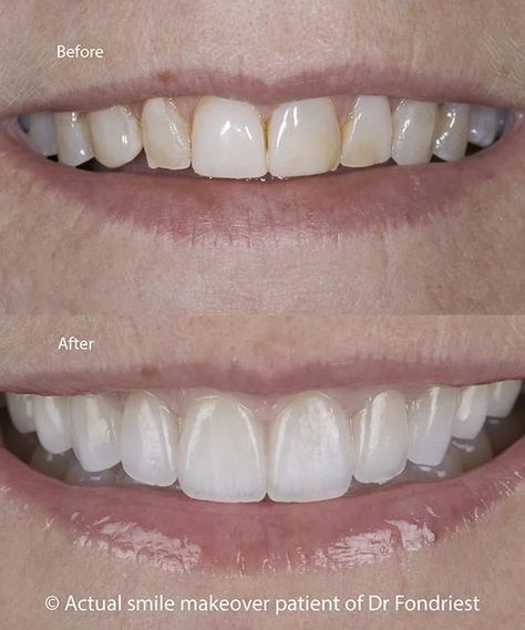 Tooth Bonding Before And After, Composite Bonding Teeth Before And After, Edge Bonding Teeth, Composite Veneers Teeth, Composite Bonding Before And After, Composite Veneers Before And After, Teeth Bonding Before And After, Lower Bleph, Veneers Before And After