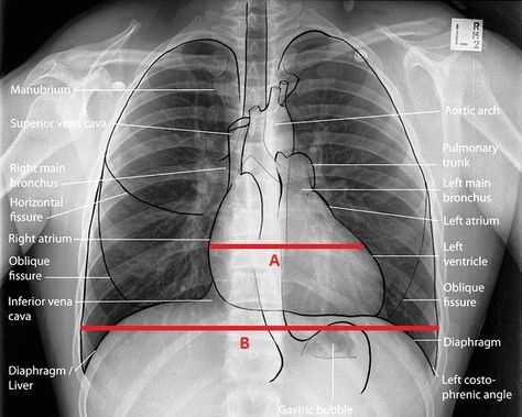 Chest Xray, Radiology Student, Medical Study, Radiology Technologist, Pa School, Nursing Life, Nurse Rock, Respiratory Therapy, Spine Health