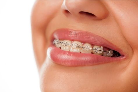 Ceramic Braces, Braces Cost, Types Of Braces, Remedies For Tooth Ache, Traditional Braces, Dentist Clinic, Clear Braces, Dental Health Care, Braces Colors