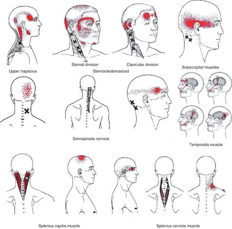 Figure 1 Referred pain patterns from upper trapezius, sternocleidomastoid, suboccipital, splenius capitis, splenius cervicis, semispinalis capitis and temporalis muscle trigger points as described by Simons et al. Reprinted with permission from Simons D, Travell J, Simons L. Travell & Simons myofascial pain and dysfunction: the trigger point manual, Vol. 1, 2nd edn. Baltimore: Williams & Wilkins, 1999. - "Myofascial Trigger Points and Sensitization: An Updated Pain Model for Tension Neck Muscle Pain, Punkty Spustowe, Trigger Point Release, Myofascial Pain Syndrome, Psoas Release, Referred Pain, Head Pain, Trigger Point Therapy, Trigger Point