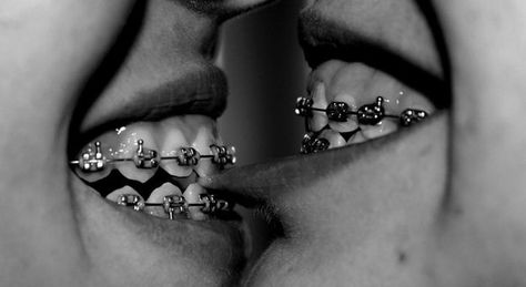 Kissing someone without braces is difficult. Kissing someone WITH braces is impossible. | 19 Moments That Will Make Anyone Who's Ever Had Braces Cringe Invisible Teeth Braces, Natural Teeth Whitening Diy, Misaligned Teeth, Adult Braces, Braces Girls, Invisible Braces, Brace Face, Crooked Teeth, Teeth Whitening Diy