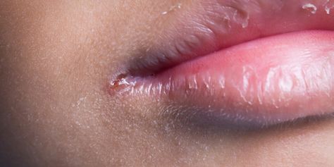 Meet your mouth’s nemesis: angular cheilitis. If you have cracks around your mouth, here's how to fix them. Corners Of Mouth Turned Down, Angular Cheilitis Remedy Natural, Mouth Sore Remedy Kids, Cracks In Corner Of Mouth, Dry Skin Around Mouth, Cracked Lip Corners, Cut On Lip, Cracked Corners Of Mouth, Mouth Sore