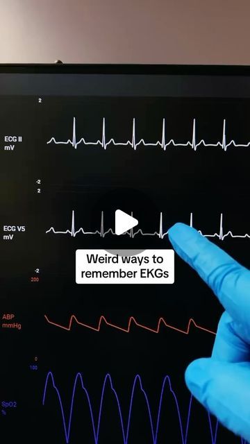 Amanda Draayer on Instagram: "EKGs Made Ridiculously Simple 🫀 👉Truth: Let’s be honest when we all first saw different EKGs, they just looked like squiggly lines. It used to feel impossible for me to interpret an EKG. Let me show you an easier way. A Normal Sinus Rhythm EKG has: 1️⃣ Spike that looks like a SAILBOAT ⛵ = QRS complex 2️⃣ 2 waves between each ⛵ = P wave + T wave 3️⃣ 60-100 BPM SINUS TACHYCARDIA = Spike ⛵ + 2 waves that come fast together. >100 BPM SINUS BRADYCARDIA = Spike ⛵ + 2 waves that are slowed apart. <60 BPM AFIB = Spike ⛵ + choppy or chaotic waves pattern on repeat AFLUTTER = Spike ⛵ + waves cut w/ a sawtooth 🪚 VTACH = Mountains of HUGE waves. 🌊🌊🌊 VTACH w/ pulse = cardiovert, VTACH w/o pulse = defibrillate VFIB = Pure chaos of waves w/ no spike ⛵. Have the V (V Nursing School Studying Cheat Sheets, Sinus Rhythm, Nursing School Organization, Med School Study, Nurse Skills, Normal Sinus Rhythm, Squiggly Lines, P Wave, Nursing School Essential