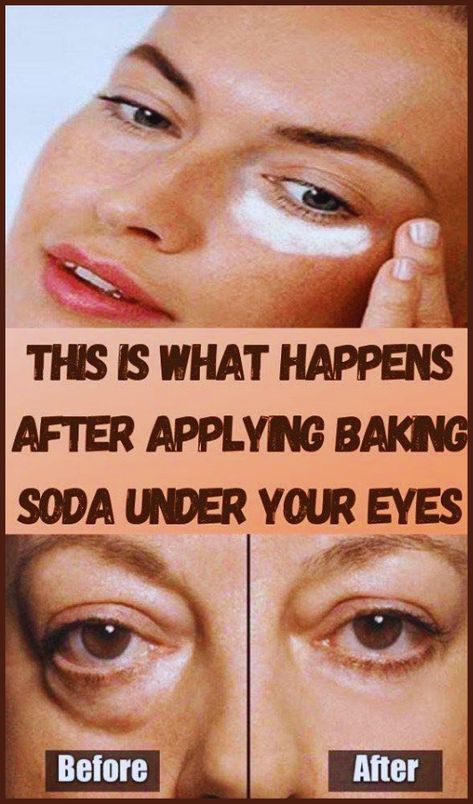 This Is What Happens After Applying Baking Soda Under Your Eyes Baking Soda Under Eyes, Undereye Bags Remedy, Eye Bag Remedies, Facial Remedies, Wrinkles On Face, Puffy Eyes Remedy, Bags Under Eyes, Baking Soda Face, Wrinkle Remedies